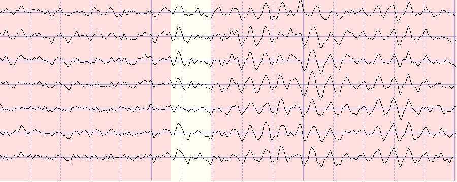 ADHD Brainwave Example 2